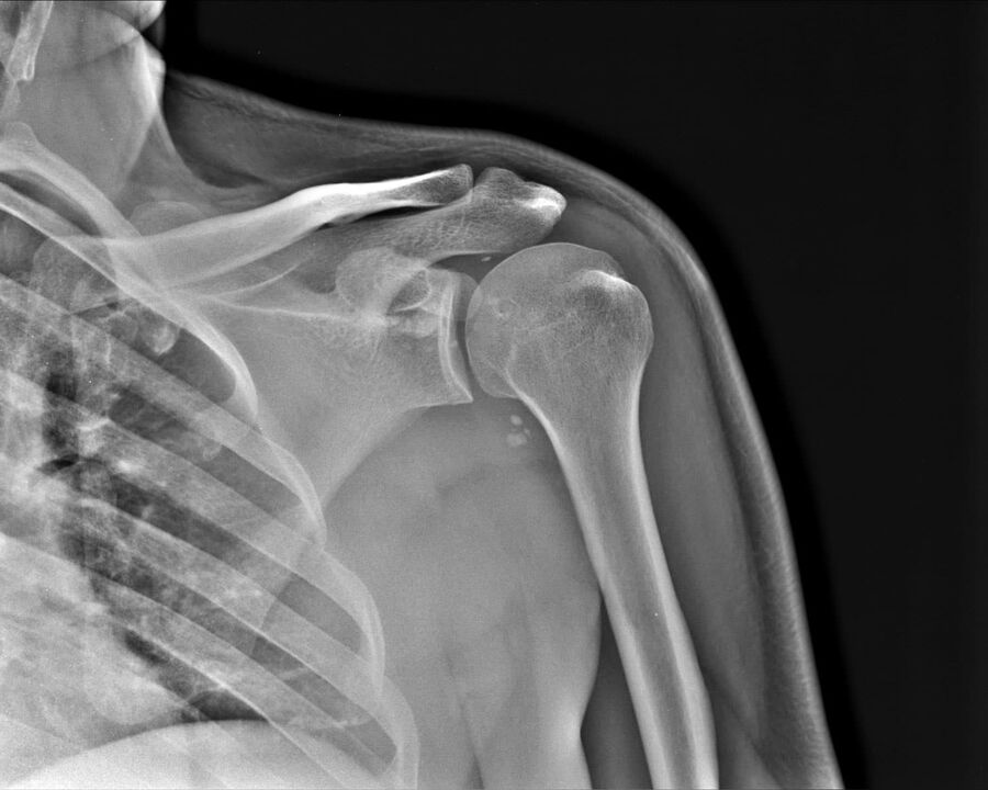 Radiografía de artrose da articulación do ombreiro de 2º grao de gravidade