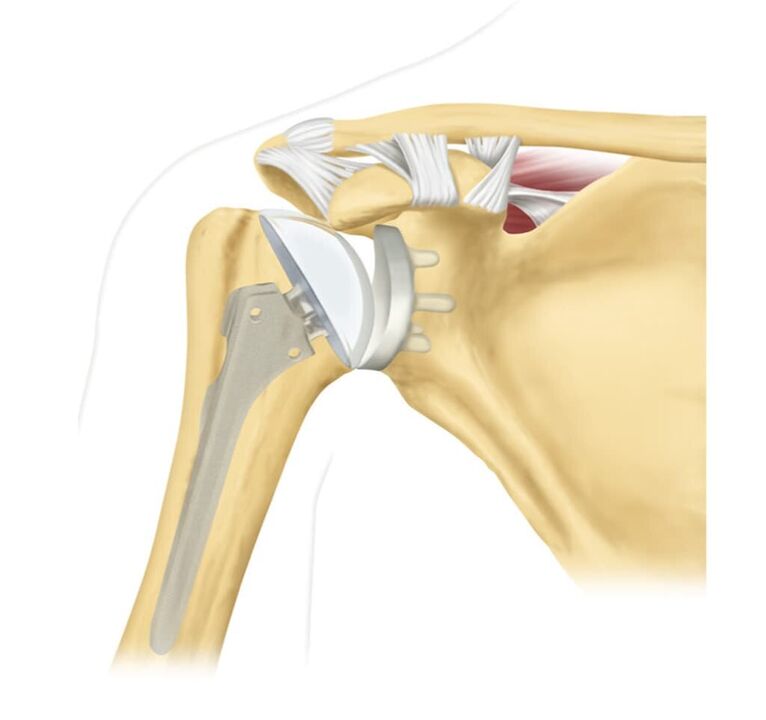 Substitución dunha articulación do ombreiro danada por unha endoprótese