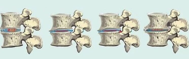 lesión espinal en caso de osteocondrose torácica