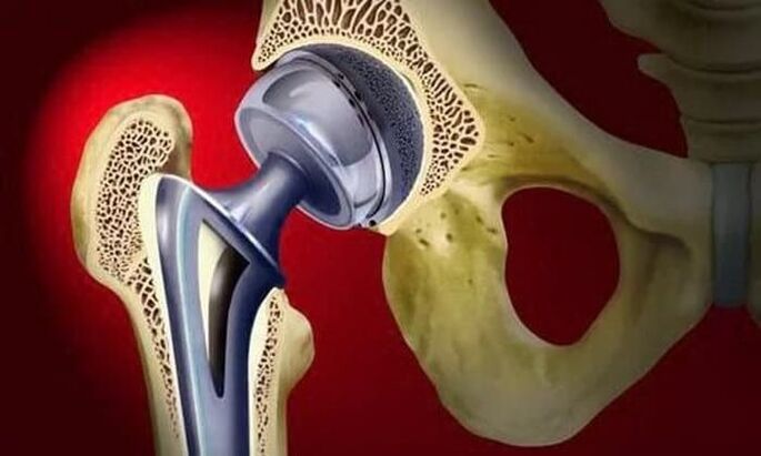 reemplazo da articulación da cadeira para a artrose