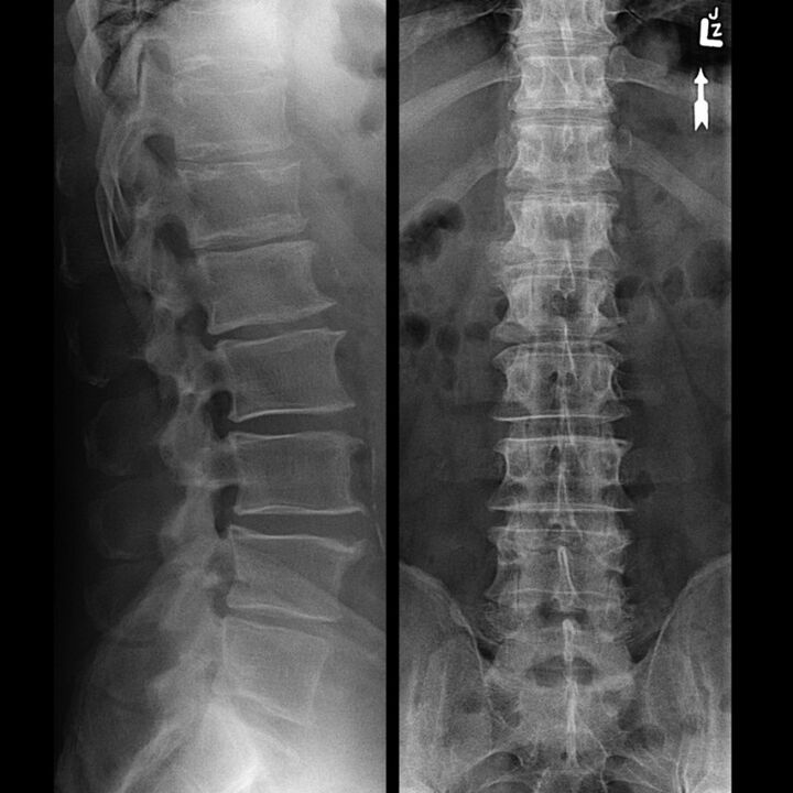 Radiografía da rexión torácica, que mostra unha diminución da brecha entre as vértebras ao longo da columna vertebral de abaixo cara arriba