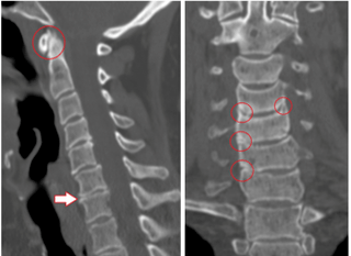 A TAC mostra vértebras e discos danados de altura heteroxénea debido á osteocondrose torácica
