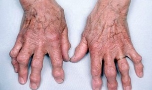 como distinguir a artrite dos dedos da artrose