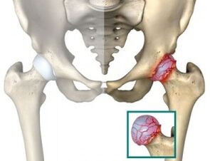 causas da atrose da articulación da cadeira