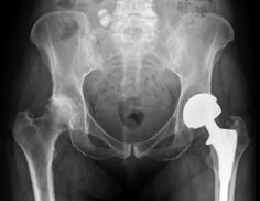 diagnóstico de artrose da articulación da cadeira