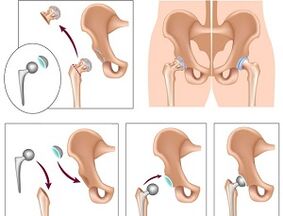 endoprótesis para artrose da articulación da cadeira
