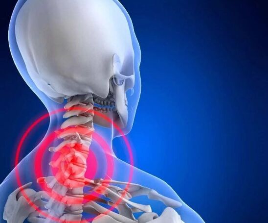 Osteocondrose cervical