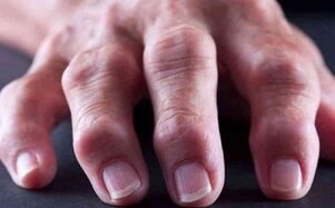 a artrite reumatoide como causa de dor nas articulacións